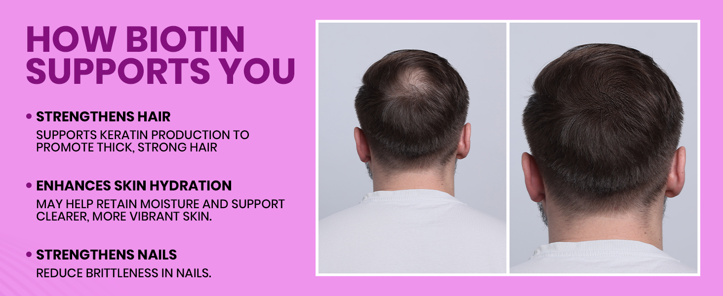 Carbamide Forte Biotin Tablets for Hair Growth | Biotin Supplement 10000 mcg | Hair Supplements for Women & Men | 120 Hair Growth Tablets - 4 Months Supply