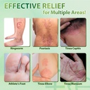 recuren-plus-jock-itch-antifungal-skin-c-71A1B7VIqwL.jpg
