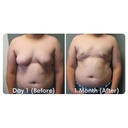 ikasus-powerful-gynecomastia-tightening--4.jpg