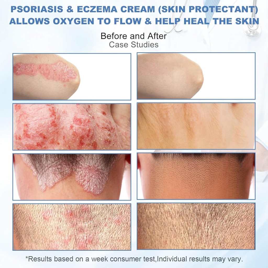bio-md-psoriasis-eczema-cream-eczema-cre-4.jpg