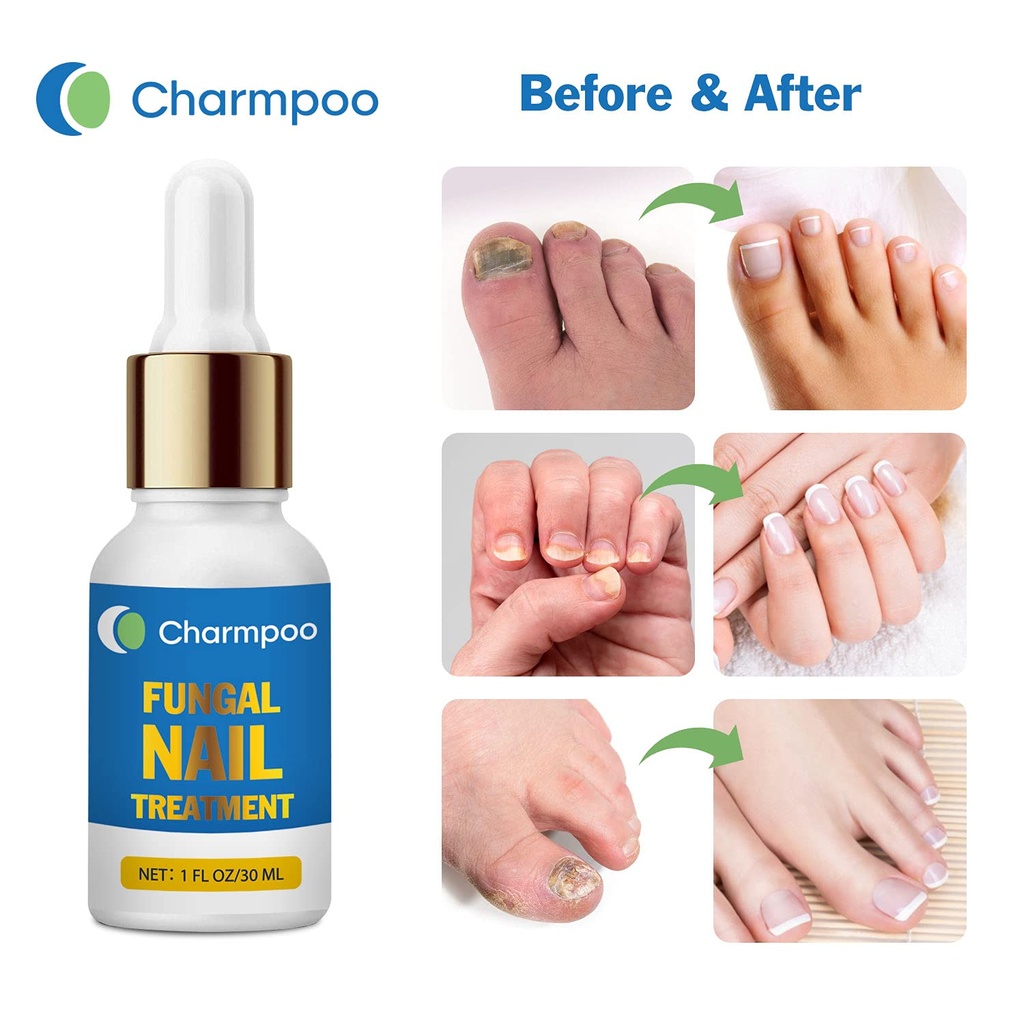 fungus-nail-treatment-for-toenail-toenai-5.jpg