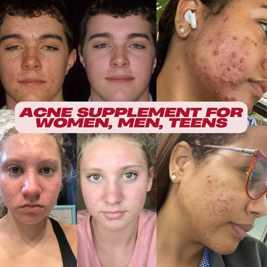 acnetame-acne-pills-vitamin-supplements--2.jpg
