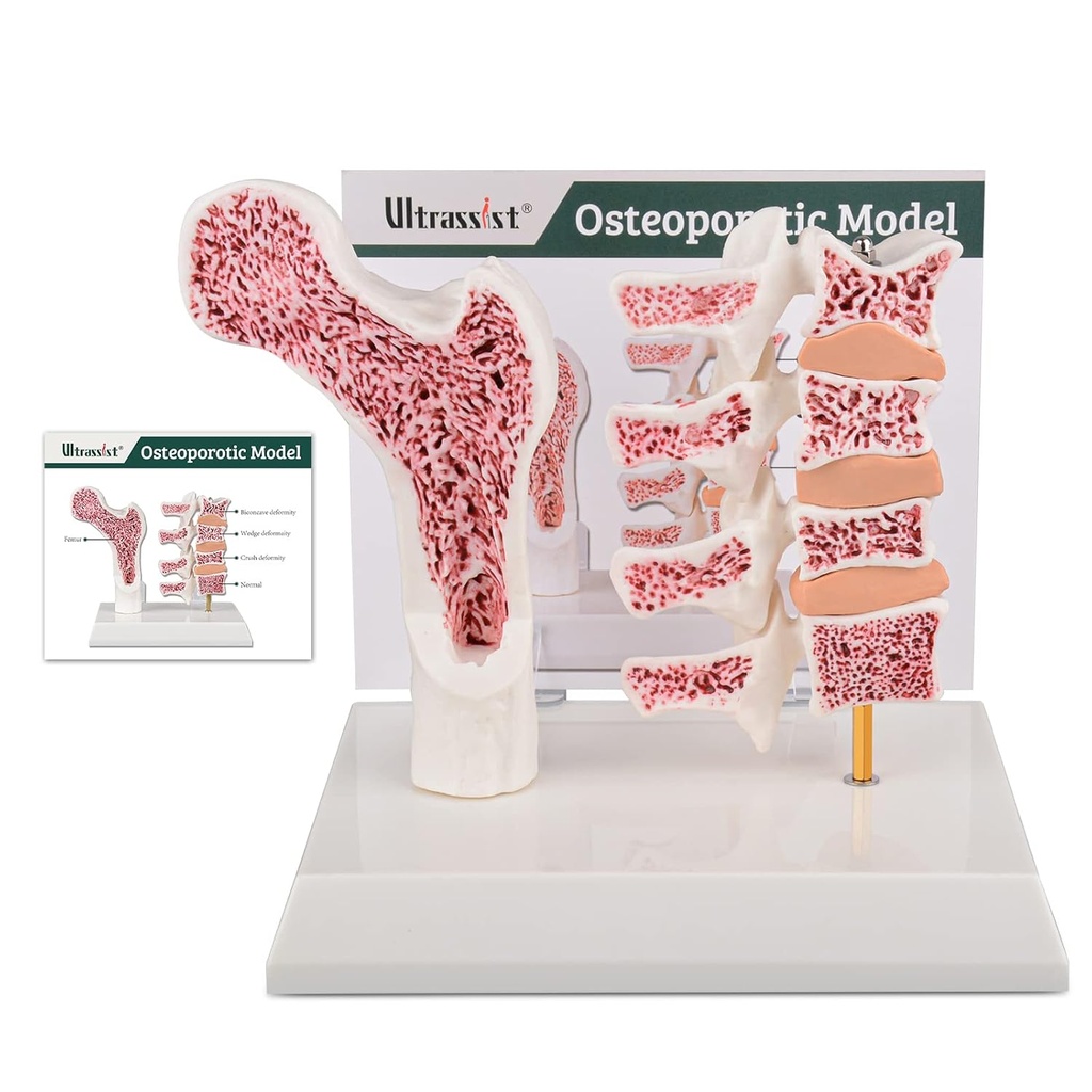 Ultrassist Human Anatomy Osteoporose Model, Vertebrae Anatomical Skeleton Model met Studiekaart voor Medical Student Teaching Demonstratie